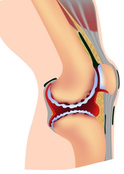 軟骨のすり減りにより軟骨粒子が関節包を傷つけてしまう。